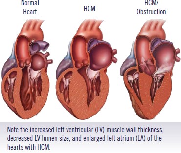 miocardiopatía hipertrófica